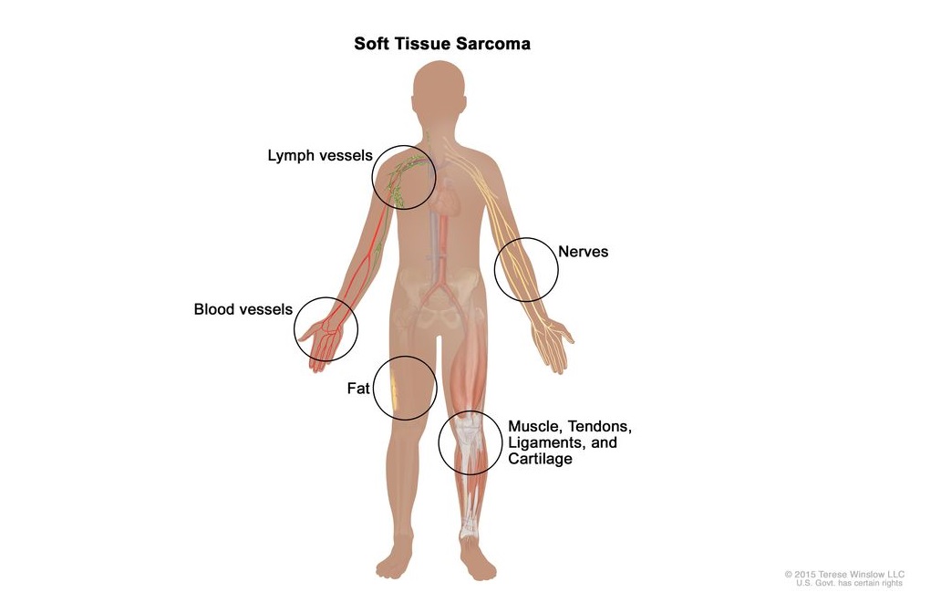 Soft Tissue Sarcoma (STS)