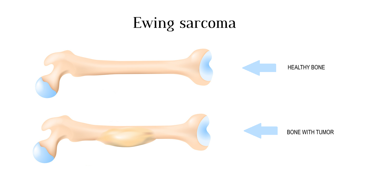 Ewing's Sarcoma