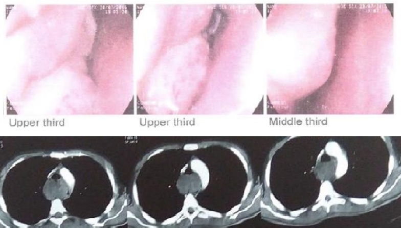 Cancer in Young People